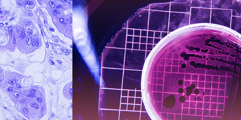 Training AI to detect cancer